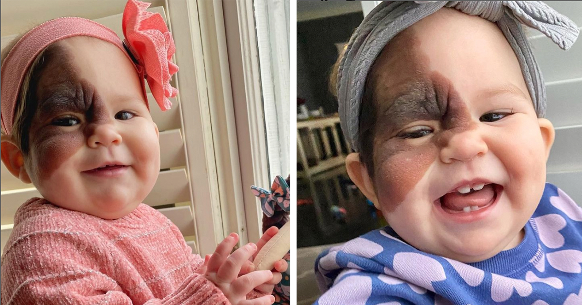 Mom on a mission to show daughter with extremely rare birthmark that she is beautiful