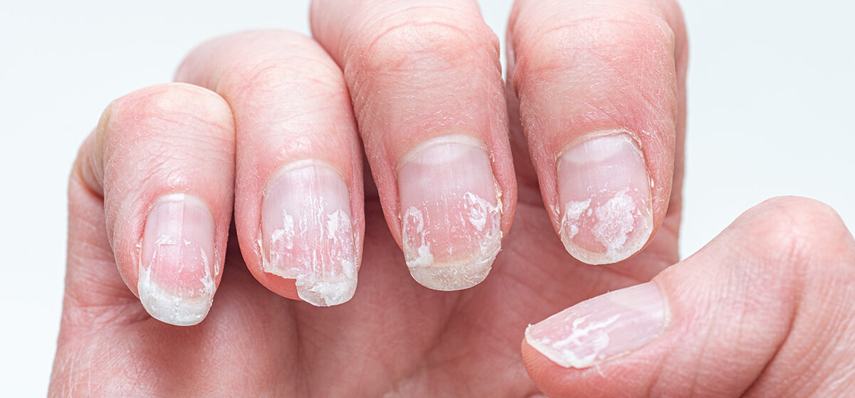 Rippled fingernails reveal secrets of possible disease