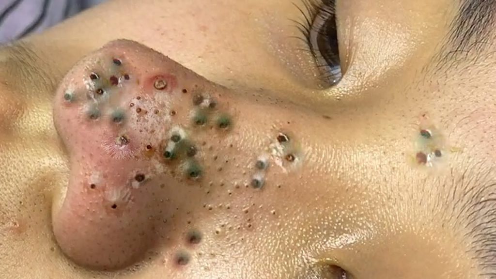 Whiteheads vs. Blackheads: Causes, Treatments, and Tips (Video)