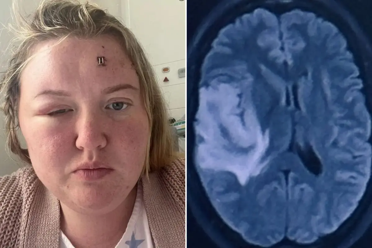 My week-long headache turned out to be a brain tumor — I had one unusual sign