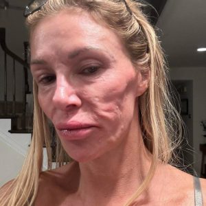 The sad reality of Brandi Glanville’s face